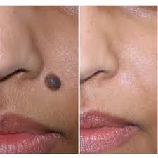what causes moles?
